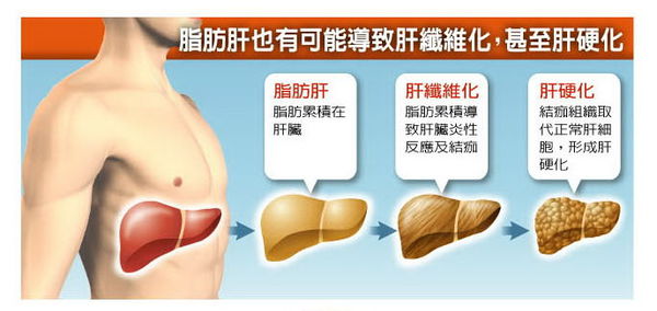 外食族脂肪肝油膩！蜆精護肝促代謝 - 20151104175559-631195015.jpg(圖)